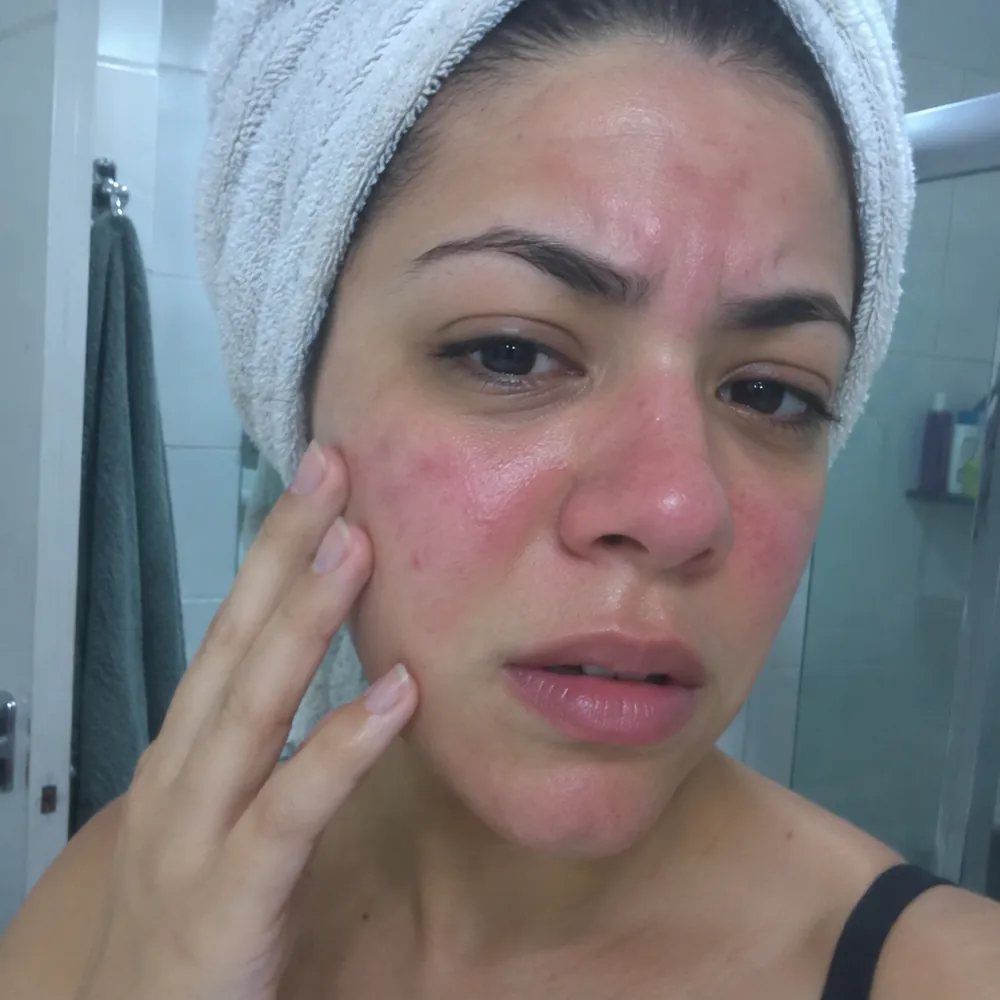 Pele vermelha e sensibilizada depois do ácido